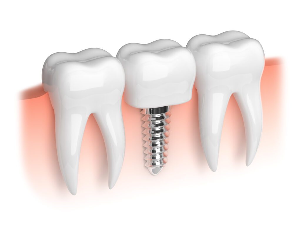 dental implants gilbert dentist